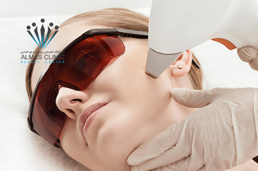 لیزر موهای زائد