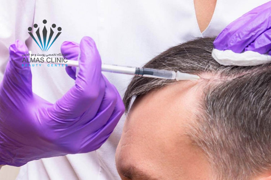 مزوتراپی مو