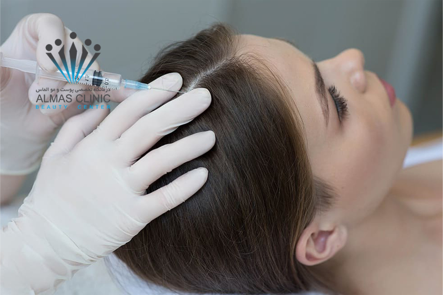 مزوتراپی مو