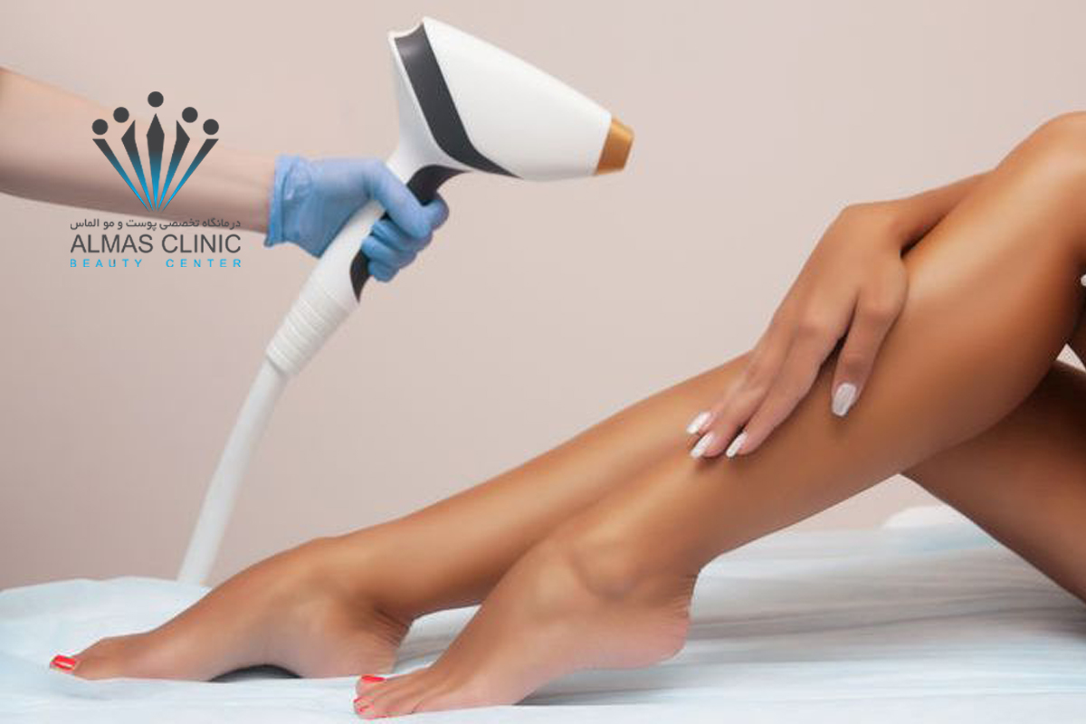 لیزر موهای زائد