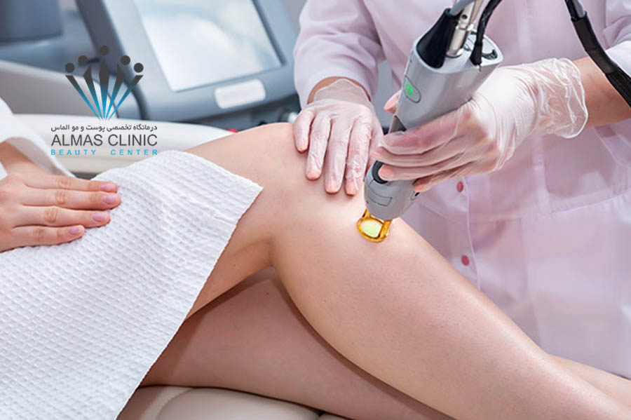 لیزر موهای زائد