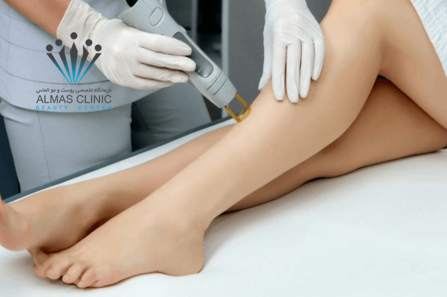 لیزر موهای زائد