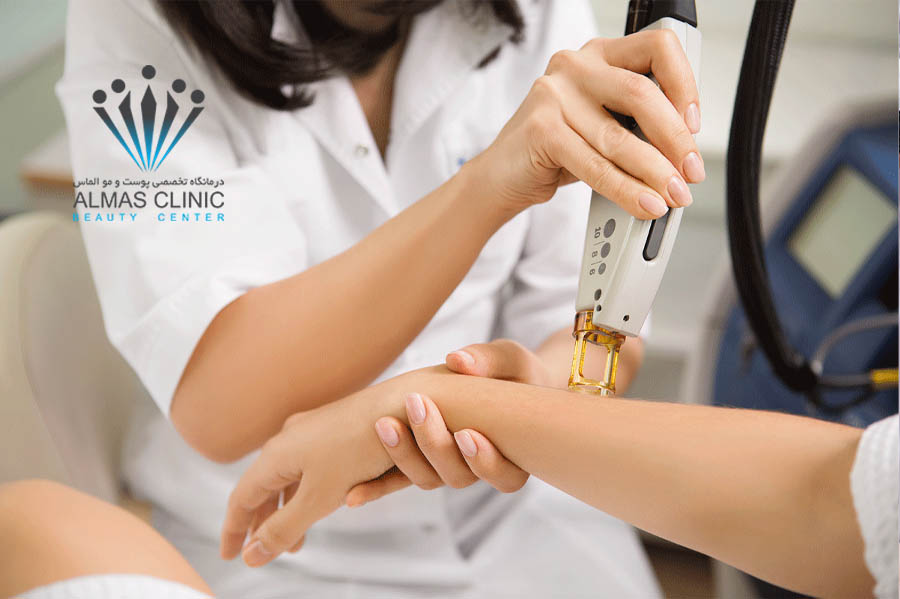 لیزر موهای زائد