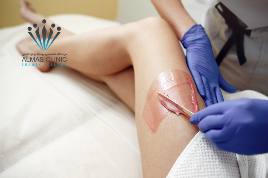 اپیلاسیون یا لیزر