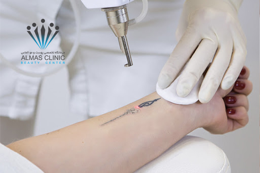 لیزر کیوسوئیچ