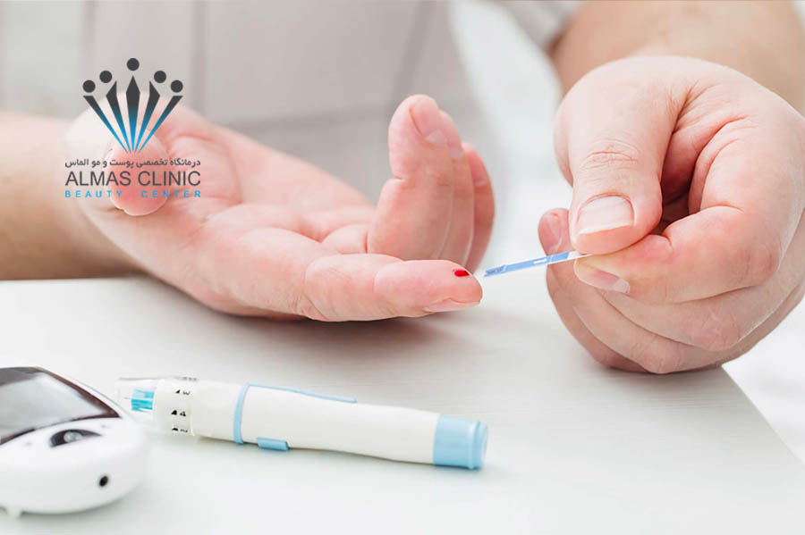 کاشت مو در افراد دیابتی