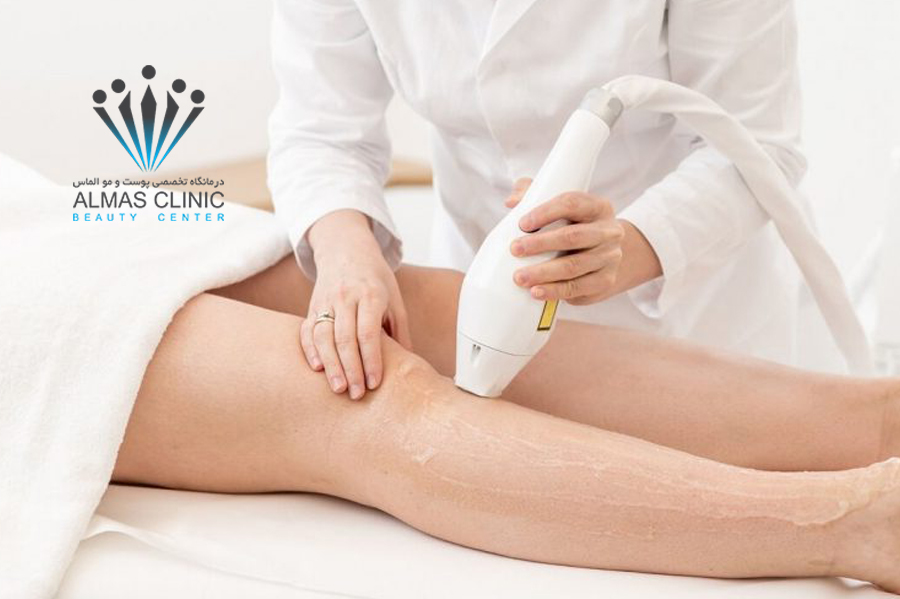 لیزر موهای زائد