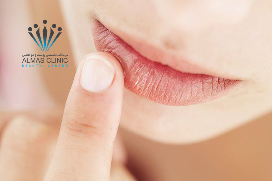 خشکی لب