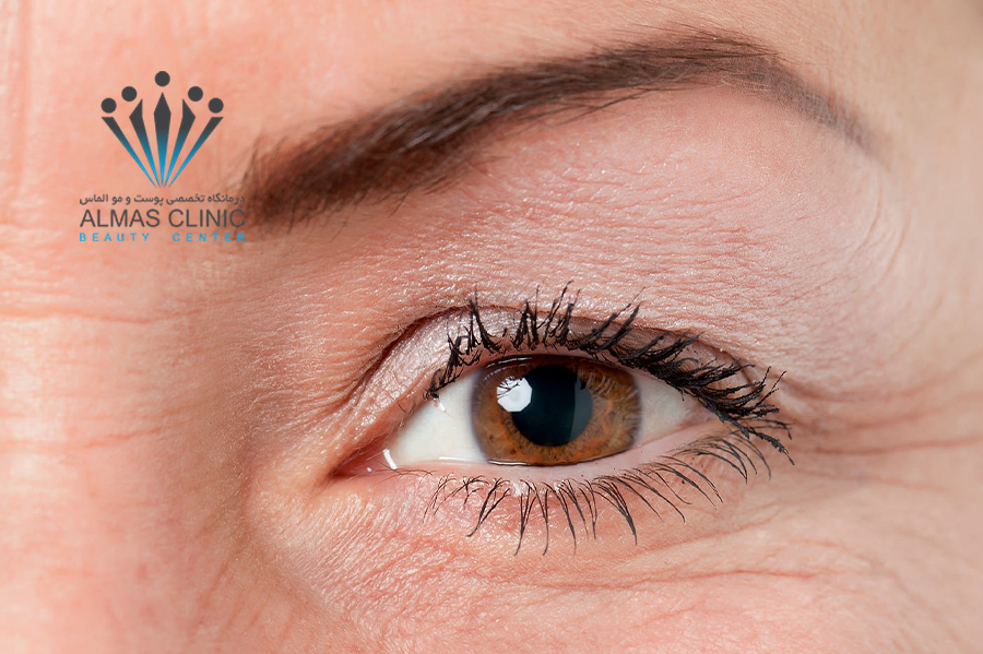 جراجی بلفاروپلاستی پلک ها