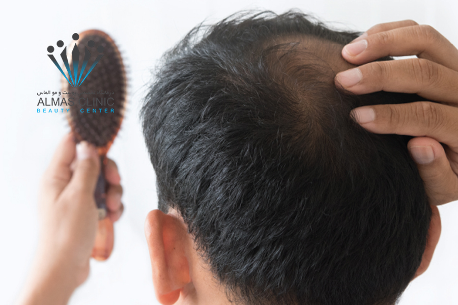 ریزش مو در جوانی