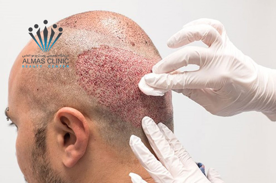 شستشوی موها بعد از کاشت مو