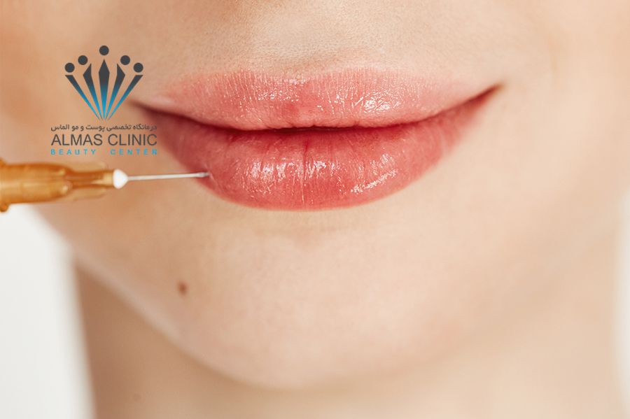 نحوه تزریق فیلر لب