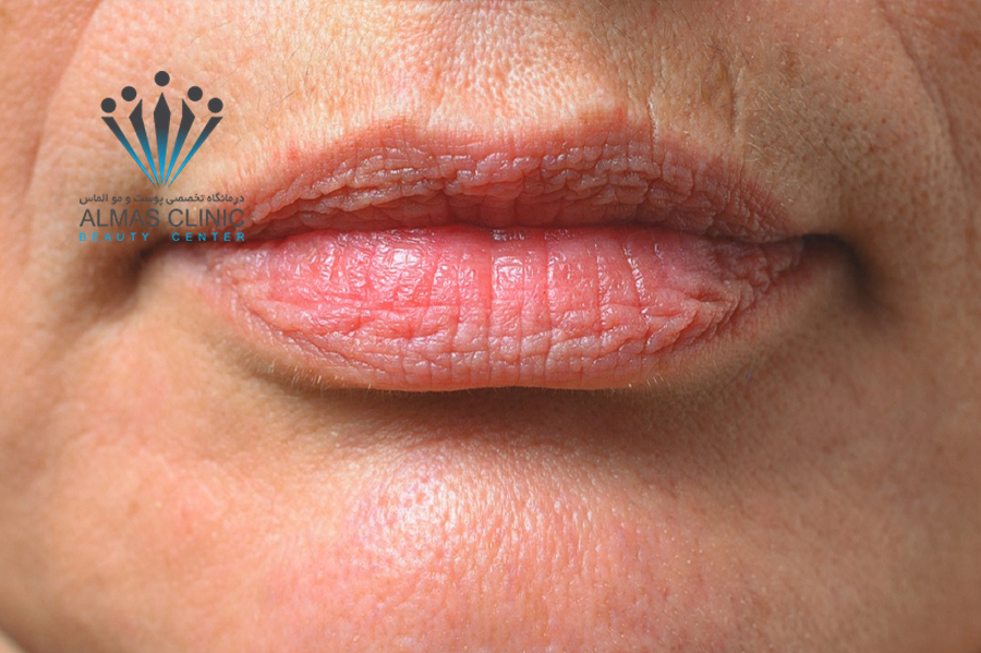 چین و چروک اطراف لب