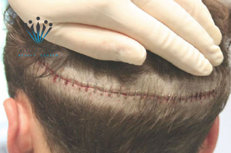 کاشت مو در محل شکستگی 