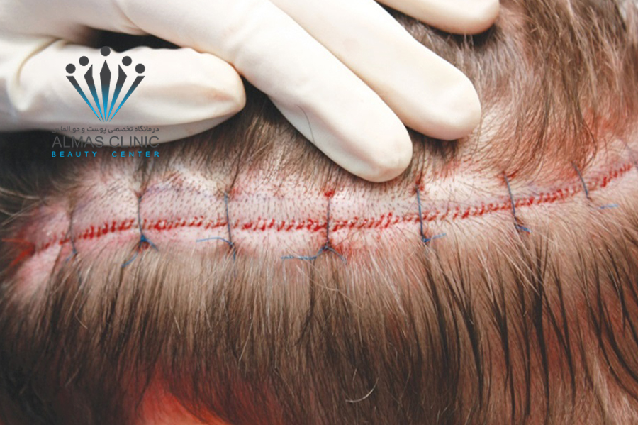 کاشت مو در محل شکستگی 