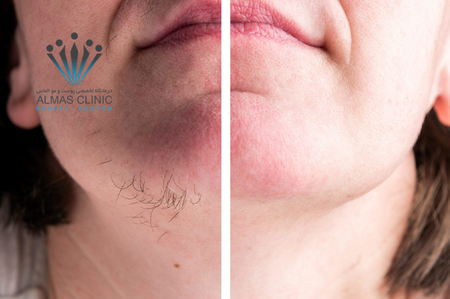 قبل و بعد لیزر موهای زائد صورت
