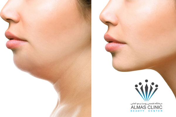 مزایا و معایب تزریق ژل چانه