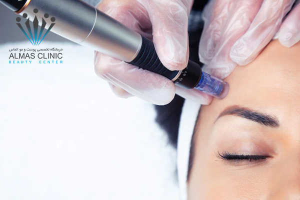 مزونیدلینگ پوست صورت چگونه انجام میشود؟