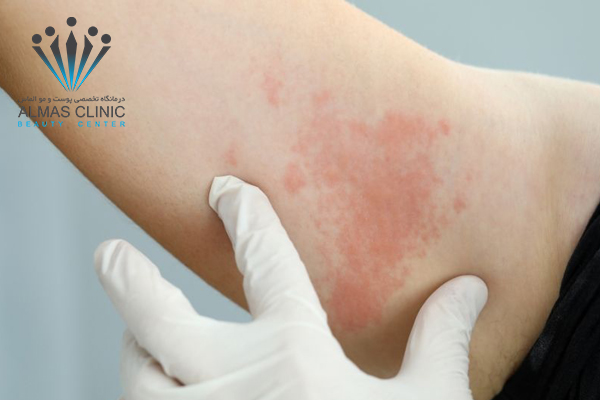 علت به وجود آمدن کهیر