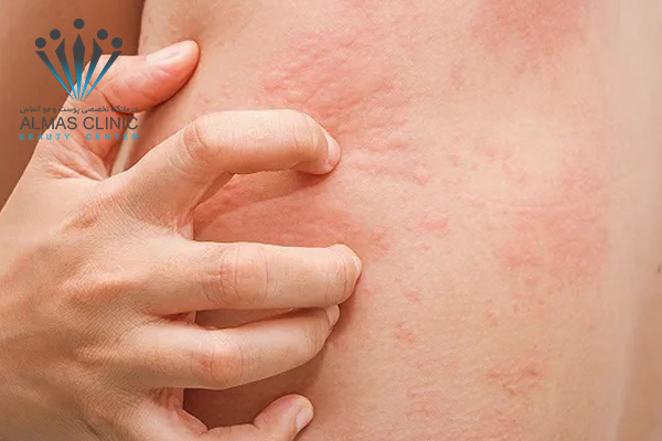 علائم و درمان کهیر چیست؟