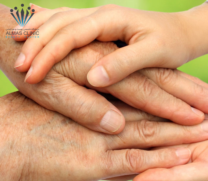 چگونه از شر لکه های پیری روی دست خلاص شویم؟